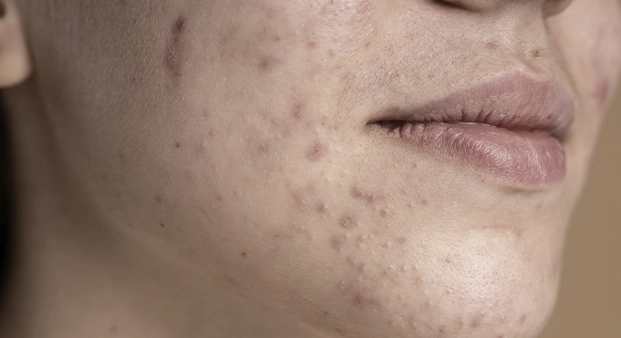 acne