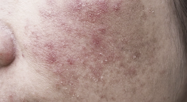 acne2
