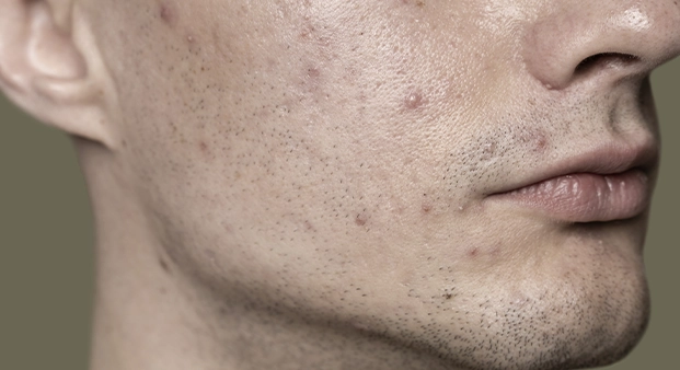 acne3