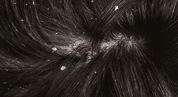 dermatite seborreia.webp 2