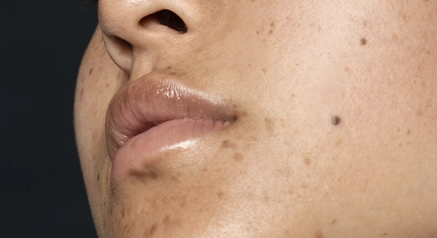 melasma 2