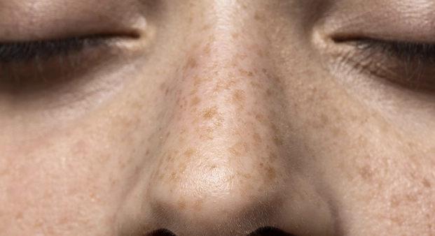 melasma1