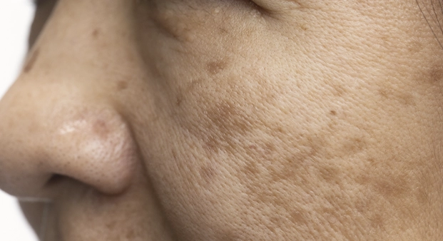 melasma3