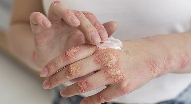 psoriase