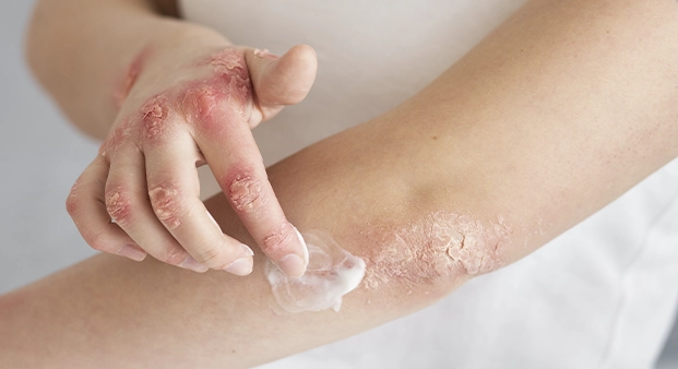psoriase2