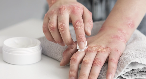 psoriase3