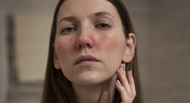 rosacea