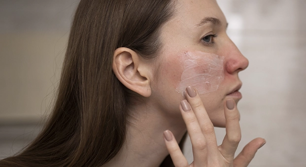 rosacea1