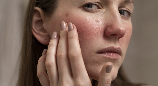 rosacea2